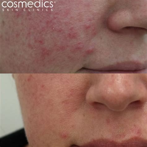 Laser Rosacea/Redness Treatment | Cosmedics Skin Clinics