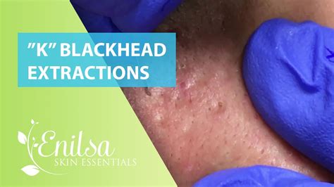 Blackheads Extractions “K’s” 3rd Treatment - YouTube