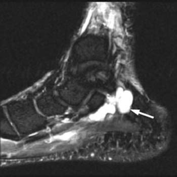 Tarsal Tunnel Syndrome - Radsource