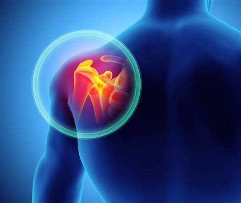 3 Ways To Treat Bone Spurs in the Shoulder - High Mountain Orthopedics