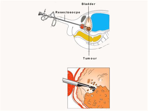 Transurethral Resection of Bladder Tumour (TURBT) - Chin Chong Min ...