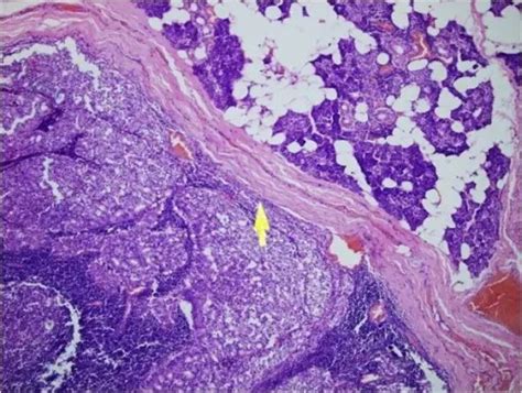 What is Acinic Cell Carcinoma? - Pathosomes