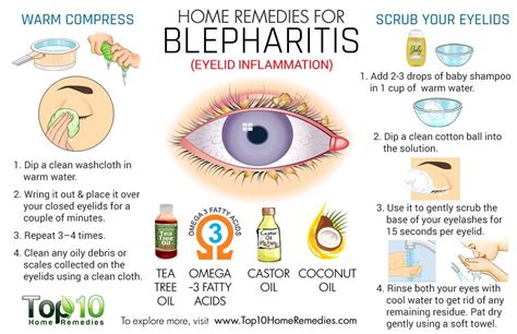 Home Remedies for Blepharitis (Eyelid Inflammation) | Top 10 Home Remedies