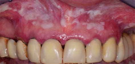 White Lesions Oral Mucosa