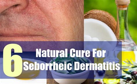 6 Natural Cure For Seborrheic Dermatitis - Natural Treatments & Cure For Seborrheic Dermatitis ...