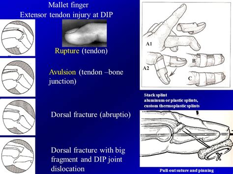 Symptoms of ruptured tendon in hand: Ruptured Tendon: Symptoms, Causes, and Treatments