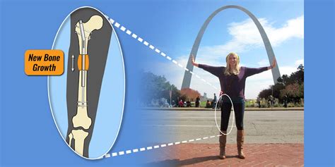 Limb Lengthening Experts in Baltimore, Maryland, USA | International Center for Limb Lengthening