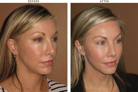 Mid Face Lift – Before and After Pictures * | Dr Turowski - Plastic Surgery Chicago