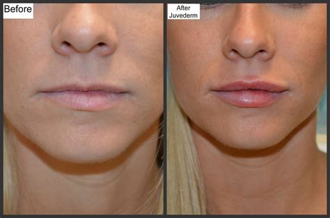 Before and After Photos- Millefiori | Dermal fillers, Restylane lips ...