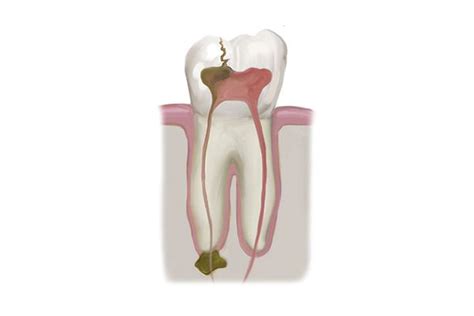 Root Canal Infection Symptoms - Birmingham, AL - Dr. Burton Gooch