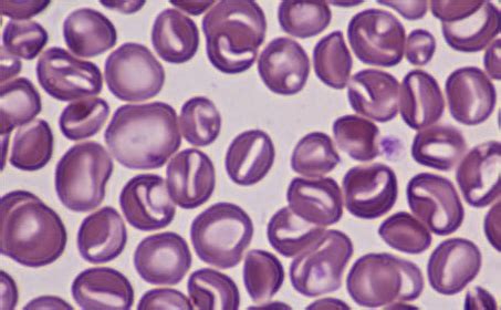 Stomatocytes on blood smear | Medical Laboratories