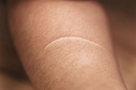 What Are the Causes of Keloid Scars?