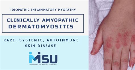 Clinically Amyopathic Dermatomyositis (CADM) - Myositis Support and Understanding