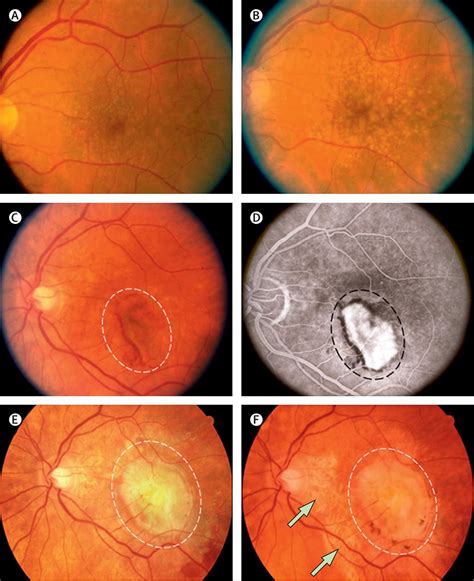 Age-related macular degeneration - The Lancet