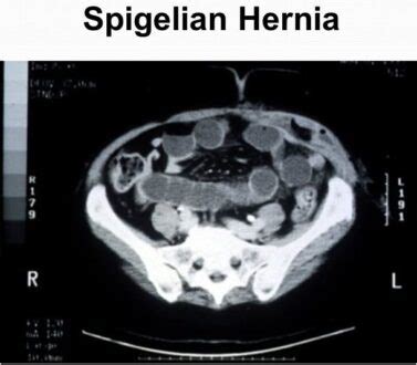 Spigelian Hernia Symptoms, CT, Pictures, Causes, Repair Procedure