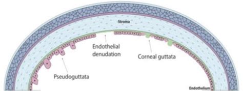 Cornea Guttata: Symptoms And Treatment | How Relate To Phaco