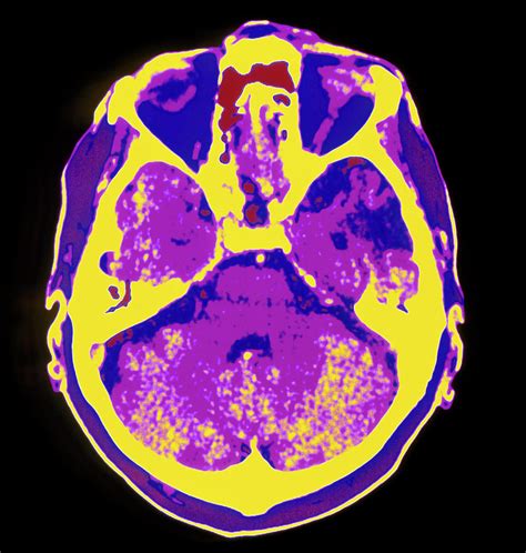 Coloured Ct Scan Of The Brain Showing A Stroke Photograph by Mehau ...