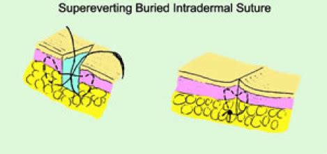 Primary Wound Closure | British Society for Dermatological Surgery