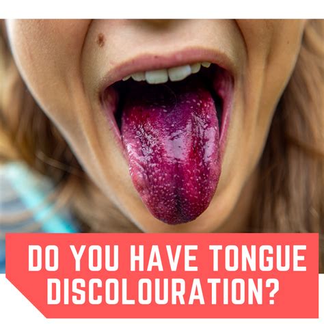 Do you have Tongue Discolouration? Causes & Treatment