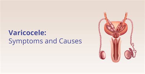 Varicocele - Causes, Symptoms & Treatment | Birla Fertility & IVF