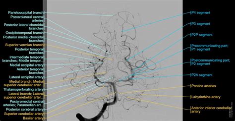 Posterior Cerebral Artery Angiogram