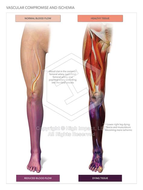 Leg Ischemia with Amputation | High Impact, LLC