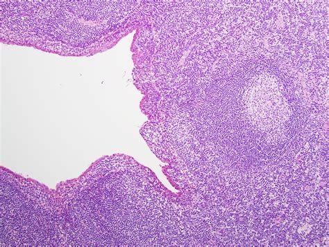 Synovial Cyst Histology