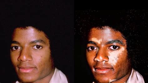 Vitiligo Michael Jackson Proof