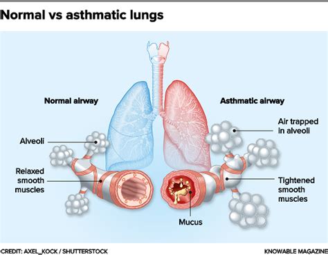 Asthma Lungs Compared To Normal Lungs