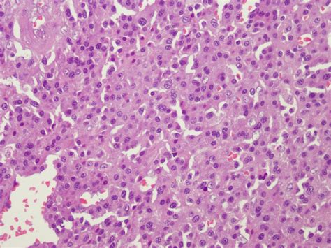 Extramedullary plasmacytoma: rare neoplasm of parotid gland | BMJ Case Reports