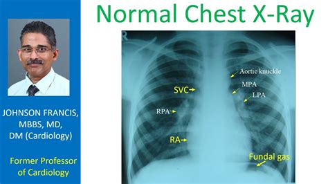 Normal Chest X Ray Images