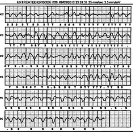 Polymorphic VT on device download | Download Scientific Diagram