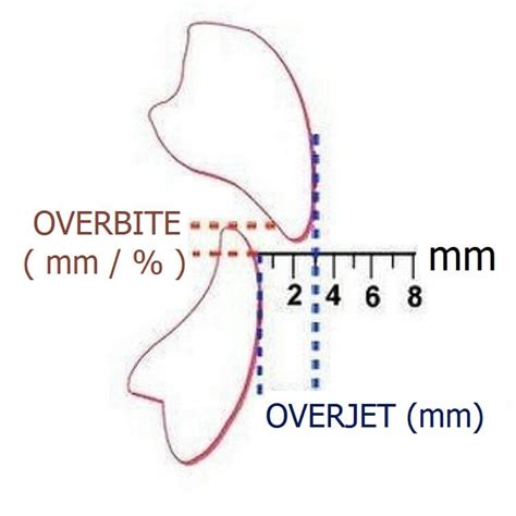 Malocclusion - difference between overbite, overjet and open bite ...