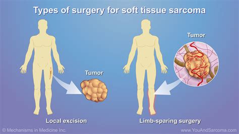 Diagnosing and Treating Soft Tissue Sarcoma