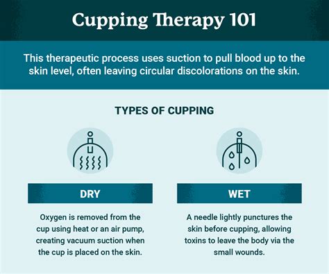 What Is Cupping Therapy? Benefits and Applications | USAHS