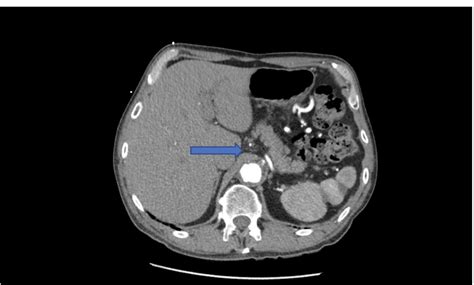 Cureus | An Atypical Presentation of Median Arcuate Ligament Syndrome