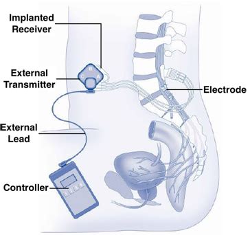 sacral nerve stimulation - Questions and Answers in MRI