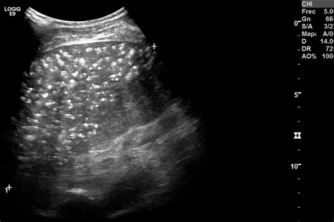 Accelerated silicosis with bone marrow, hepatic and splenic involvement in a patient with lung ...