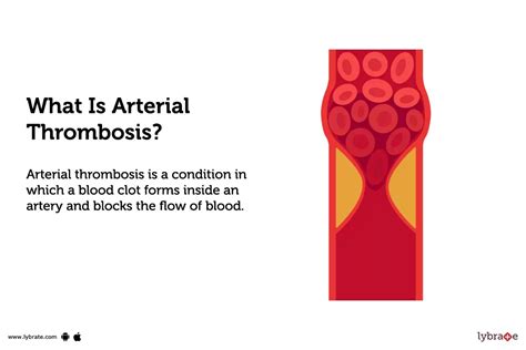 Arterial Thrombosis: Causes, Symptoms, Treatment and Cost