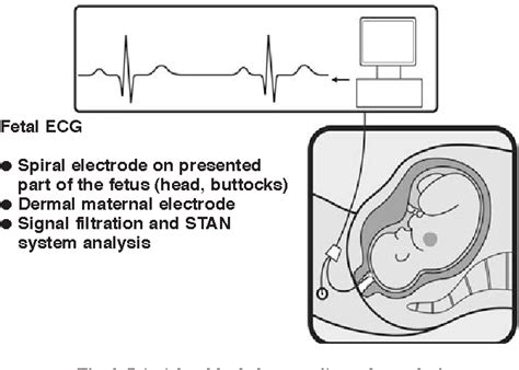 Figure 2 from Fetal ECG in the Prognosis of Fetal Hypoxia | Semantic ...