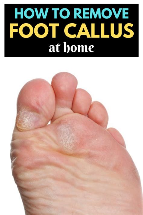 How to get rid of foot calluses with photos according to doctors – Artofit