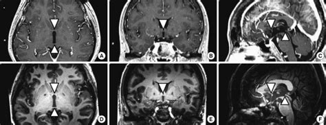 Axial, coronal, and sagittal images of the anterior commissure ( ) and... | Download Scientific ...