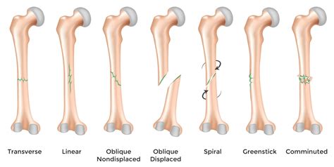 Fractures – Symptoms, Causes And Other Risk Factors