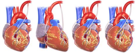 Coronary Artery Bypass Grafting – Physiomi