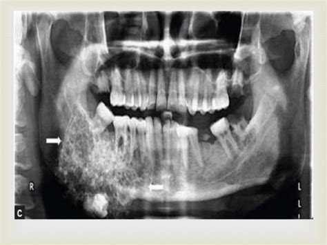 Tumor of oral cavity