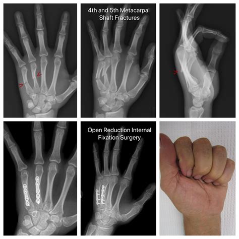 5th Metacarpal Base Fracture