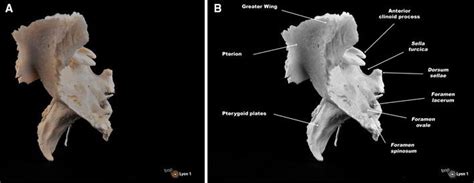 Sphenoid Bone Anatomy