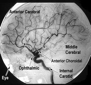 Internal Carotid Artery Angiogram