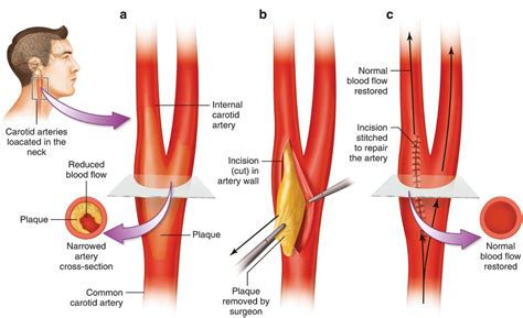 Monitoring for Carotid Endarterectomy | Neupsy Key