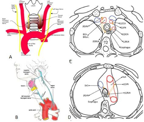 Figure 1 from Unilateral vocal cord paralysis: a review of CT findings ...